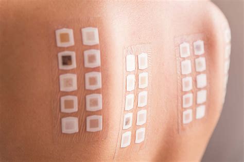 ALLERGY TEST .